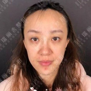 瑞麗舍整形馬君做的全臉自體脂肪填充，不錯呢~