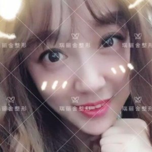 瑞麗舍整形馬君做的全臉自體脂肪填充，不錯呢~