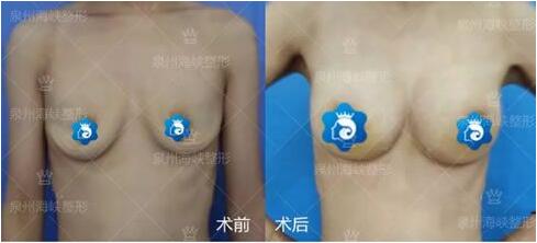 亓發(fā)芝做產(chǎn)后乳房萎縮下垂隆胸案例