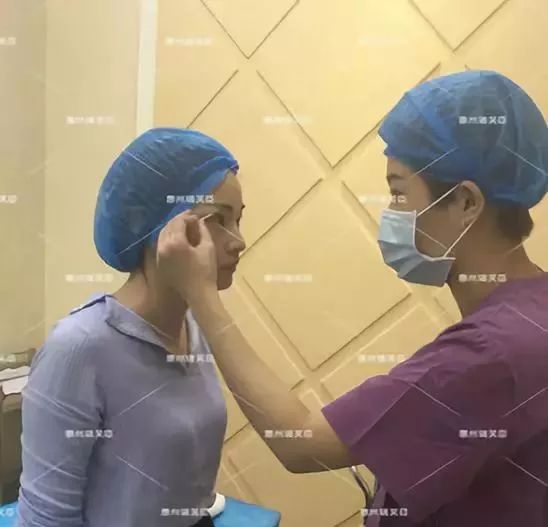 惠州瑞芙臣劉丹虹雙眼皮+開眼角整形日記~