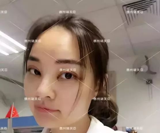 惠州瑞芙臣劉丹虹雙眼皮+開眼角整形日記~