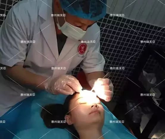 惠州瑞芙臣劉丹虹雙眼皮+開眼角整形日記~