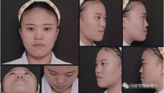 劉彥君隆鼻案例圖恢復(fù)記錄