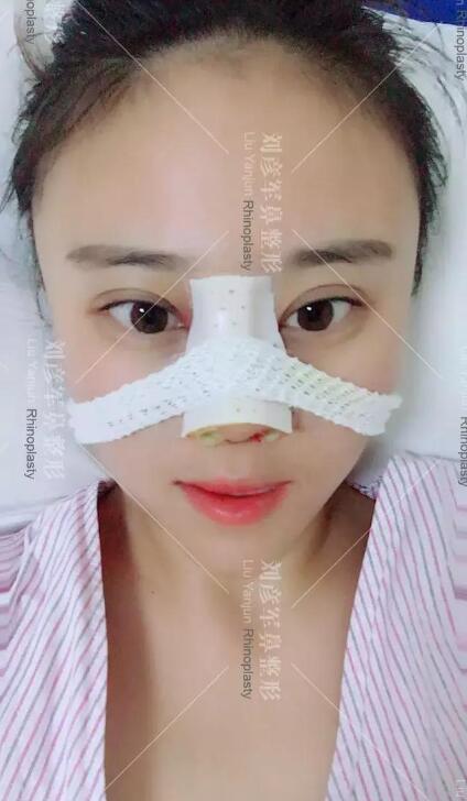 劉彥君隆鼻案例圖恢復(fù)記錄