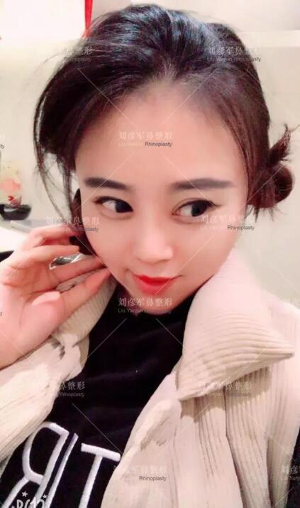 劉彥君隆鼻案例圖恢復(fù)記錄