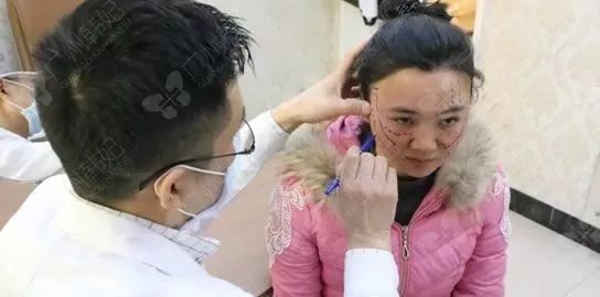 廣州韓妃美版超聲提拉和埋線提升提升日記一則，給你好看~