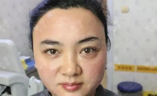 廣州韓妃美版超聲提拉和埋線提升提升日記一則，給你好看~