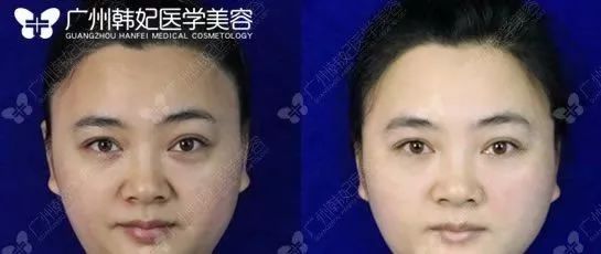 廣州韓妃美版超聲提拉和埋線提升提升日記一則，給你好看~