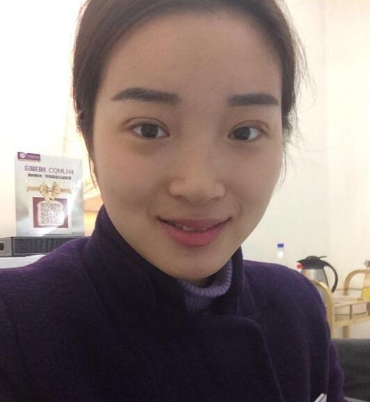 深圳陽光醫(yī)院雙眼皮一個月恢復(fù)圖 日記見證蛻變