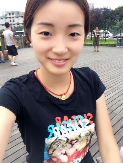 深圳陽光醫(yī)院雙眼皮一個月恢復(fù)圖 日記見證蛻變