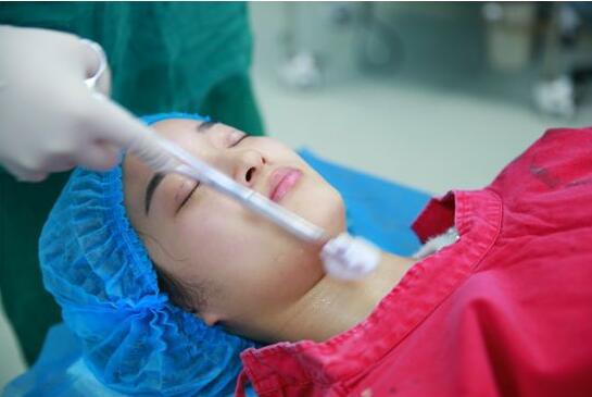 深圳陽光醫(yī)院雙眼皮一個月恢復(fù)圖 日記見證蛻變