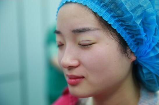 深圳陽光醫(yī)院雙眼皮一個月恢復(fù)圖 日記見證蛻變