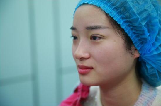 深圳陽光醫(yī)院雙眼皮一個月恢復(fù)圖 日記見證蛻變