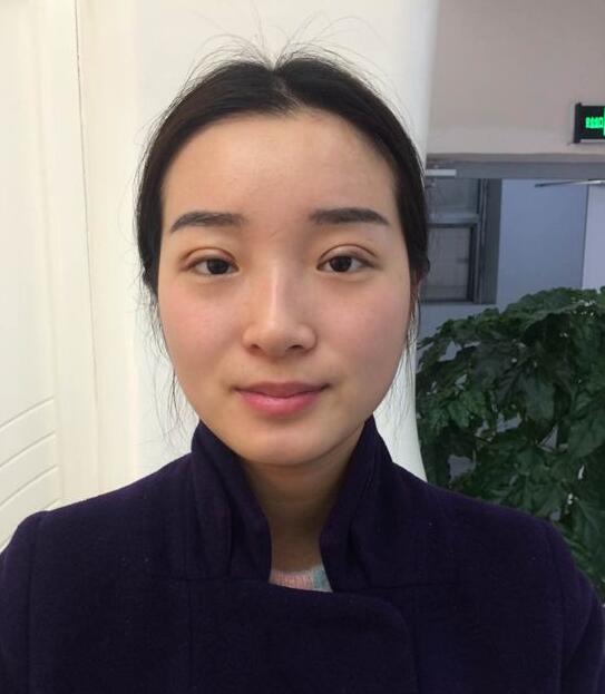 深圳陽光醫(yī)院雙眼皮一個月恢復(fù)圖 日記見證蛻變