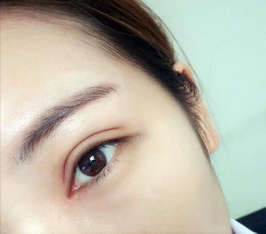 重慶五洲整形醫(yī)院醫(yī)生技術(shù)口碑|雙眼皮案例實記分享