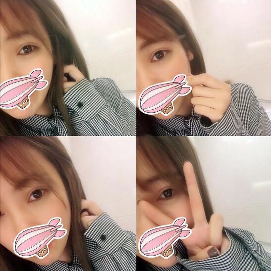 重慶五洲整形醫(yī)院醫(yī)生技術(shù)口碑|雙眼皮案例實記分享