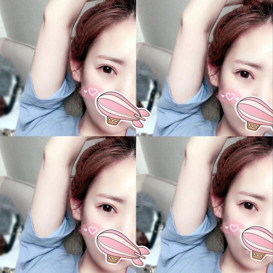 重慶五洲整形醫(yī)院醫(yī)生技術(shù)口碑|雙眼皮案例實記分享