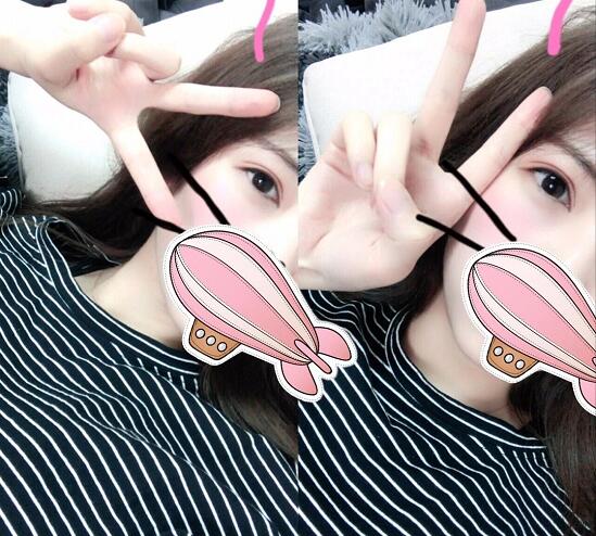 重慶五洲整形醫(yī)院醫(yī)生技術(shù)口碑|雙眼皮案例實記分享