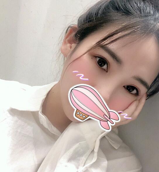 重慶五洲整形醫(yī)院醫(yī)生技術(shù)口碑|雙眼皮案例實記分享