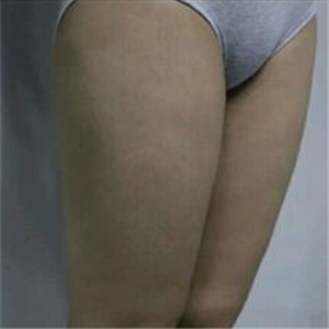 去找東方和諧馮斌做了大腿抽脂，分享一下果吧！