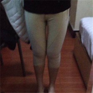 做完大腿吸脂手術半年了 瘦了6厘米