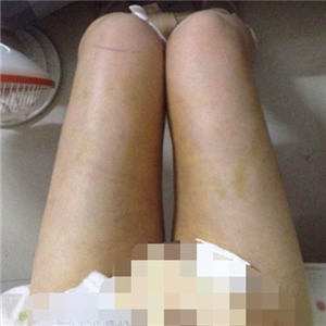 做完大腿吸脂手術半年了 瘦了6厘米