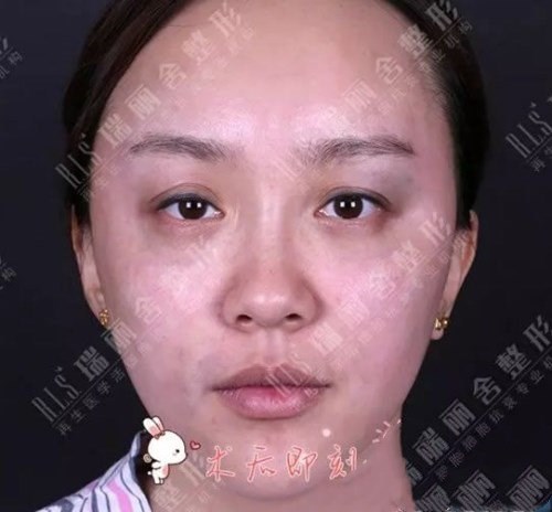 臉頰凹陷部位做完脂肪填充果