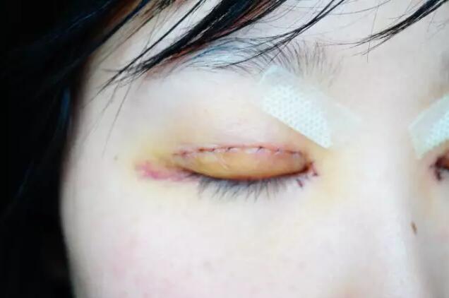 張毅整形醫(yī)生雙眼皮圖分享日記手札