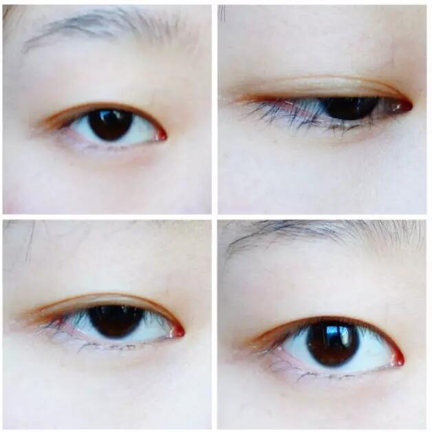 張毅整形醫(yī)生雙眼皮圖分享日記手札