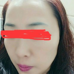 北京邦定張亞昆做的面部提升，果較為不錯(cuò)~