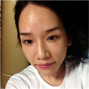 北京南加高紅霞醫(yī)生做的頭發(fā)種植，恢復(fù)得很好~