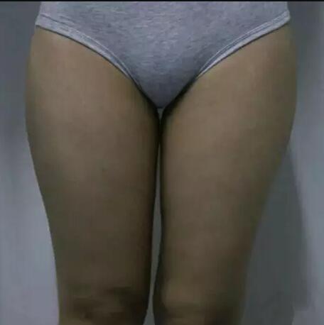 哈醫(yī)大二院整形科徐學(xué)武大腿吸脂術(shù)前后恢復(fù)分享手記