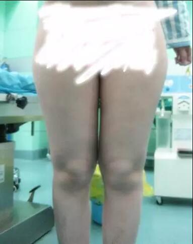 哈醫(yī)大二院整形科徐學(xué)武大腿吸脂術(shù)前后恢復(fù)分享手記