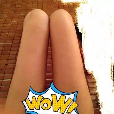 哈醫(yī)大二院整形科徐學(xué)武大腿吸脂術(shù)前后恢復(fù)分享手記