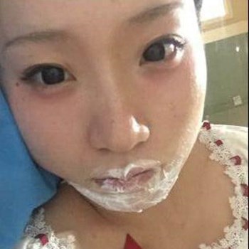 北京麗詩(shī)麗格楊明強(qiáng)玻尿酸豐唇半個(gè)月了，看看果~