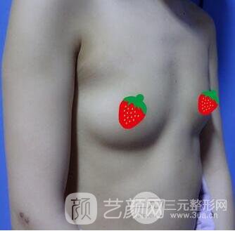 北京伊美爾何禎平假體豐胸照片四個月恢復(fù)手記