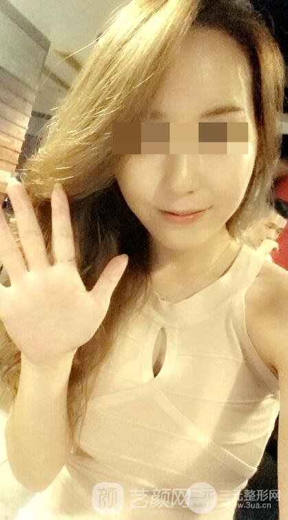 北京隆胸抽脂多少錢(qián)?北京東方和諧自體脂肪豐胸案例