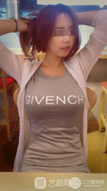 北京隆胸抽脂多少錢(qián)?北京東方和諧自體脂肪豐胸案例