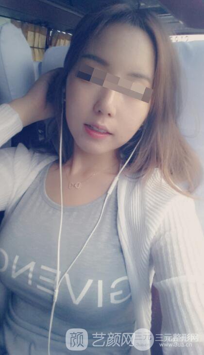 北京隆胸抽脂多少錢(qián)?北京東方和諧自體脂肪豐胸案例