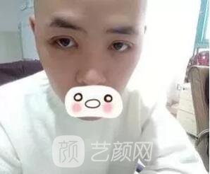 愛思特張姣姣雙眼皮案例照片日記 男生也會做雙眼皮手術(shù)哦