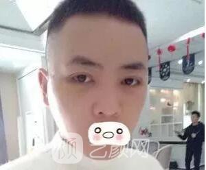 愛思特張姣姣雙眼皮案例照片日記 男生也會做雙眼皮手術(shù)哦