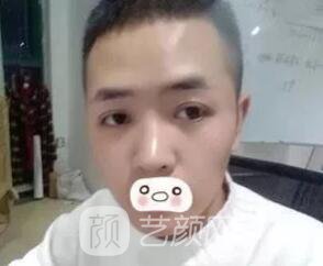 愛思特張姣姣雙眼皮案例照片日記 男生也會做雙眼皮手術(shù)哦