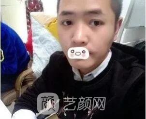 愛思特張姣姣雙眼皮案例照片日記 男生也會做雙眼皮手術(shù)哦