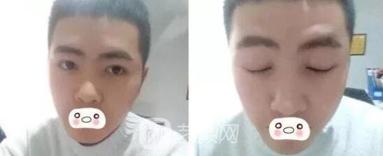 愛思特張姣姣雙眼皮案例照片日記 男生也會做雙眼皮手術(shù)哦