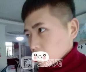 愛思特張姣姣雙眼皮案例照片日記 男生也會做雙眼皮手術(shù)哦