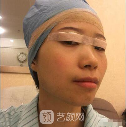 莊璐全切雙眼皮照 全過程恢復(fù)經(jīng)驗之談