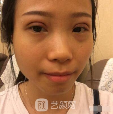 莊璐全切雙眼皮照 全過程恢復(fù)經(jīng)驗之談