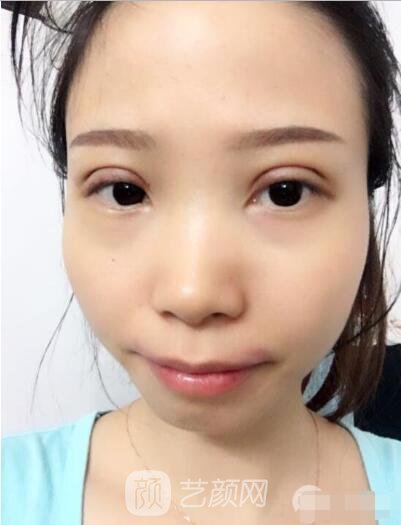 莊璐全切雙眼皮照 全過程恢復(fù)經(jīng)驗之談