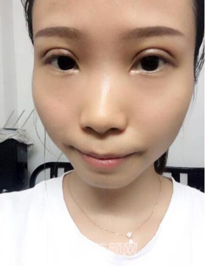 莊璐全切雙眼皮照 全過程恢復(fù)經(jīng)驗之談