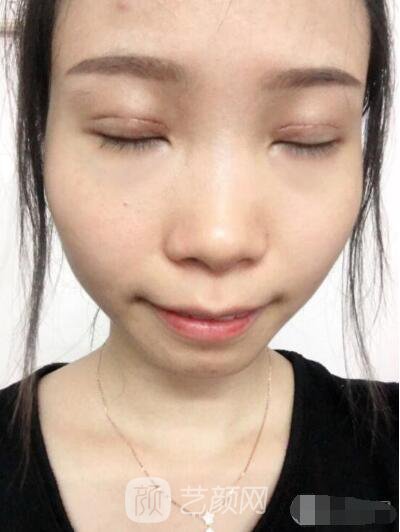 莊璐全切雙眼皮照 全過程恢復(fù)經(jīng)驗之談